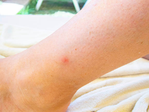 Identification of Bed Bug Bites? Pest Control Guides