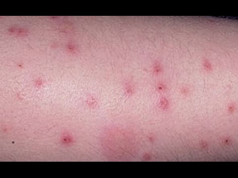Prevention Tips for Bed Bug Bites?