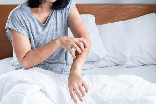 Treatment Options for Bed Bug Bites?