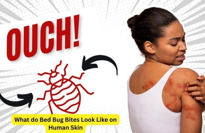 What do Bed Bug Bites Look Like on Human Skin: Identification, Treatment, and Prevention
