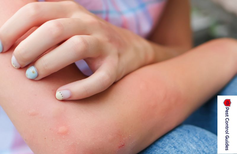 Symptoms of Bed Bug Bites?