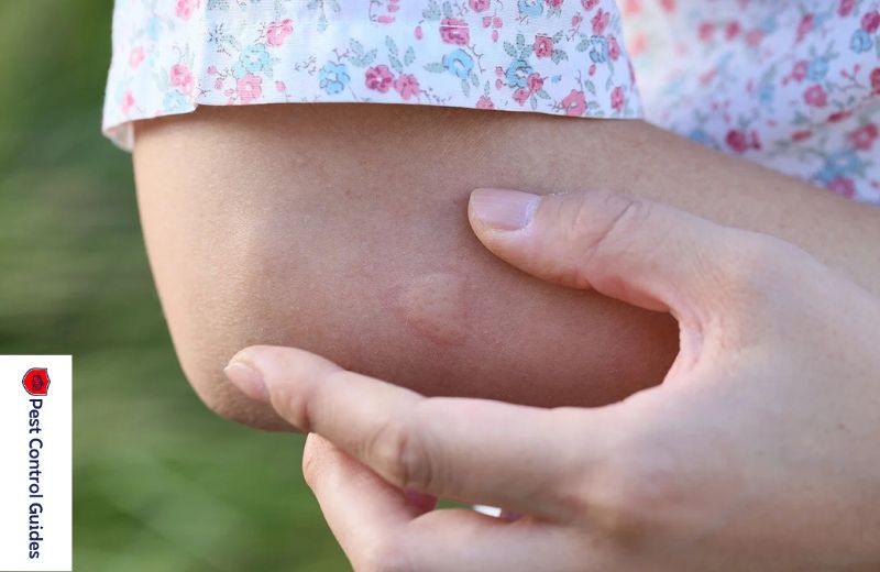 Treatment for Bed Bug Bites?